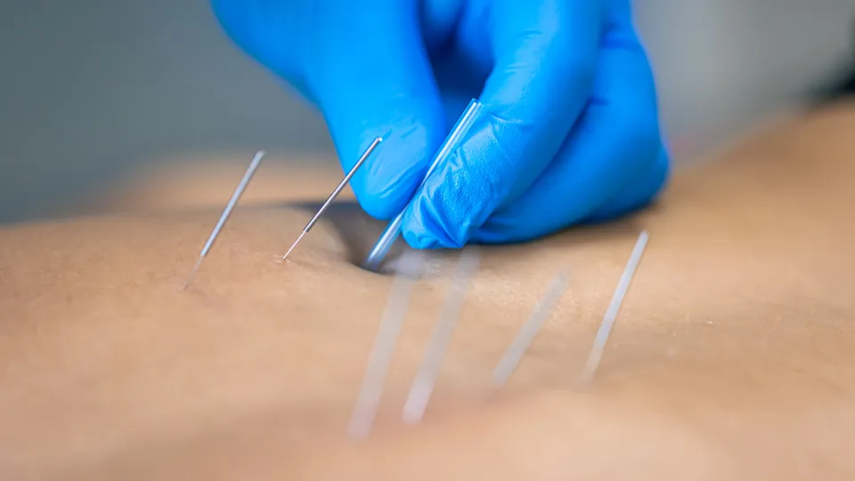 How Long Should You Rest After Dry Needling? Most People Get this Wrong