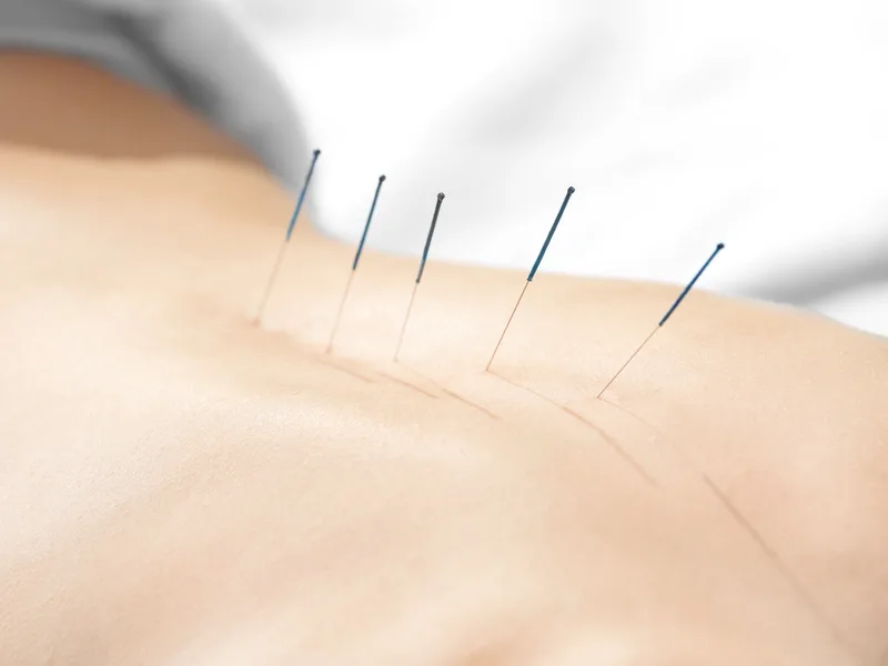 Acupuncture at Complete Chiropractic Sports & Wellness in Durham