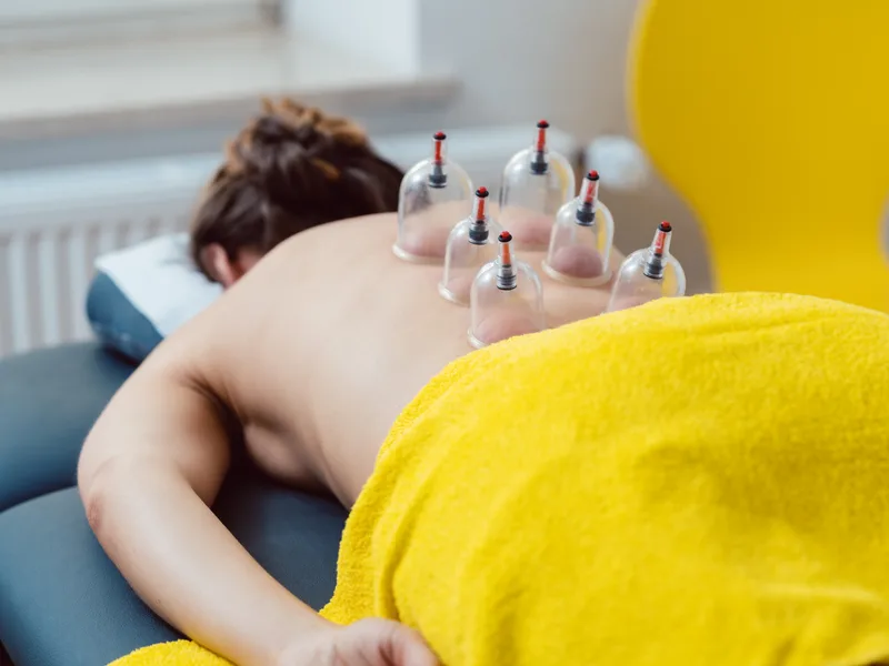 Cupping Therapy at Complete Chiropractic Sports & Wellness in Durham