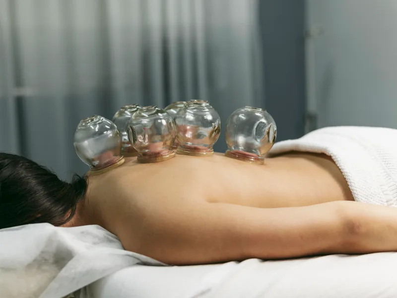 Cupping Therapy at Complete Chiropractic Sports & Wellness in Durham