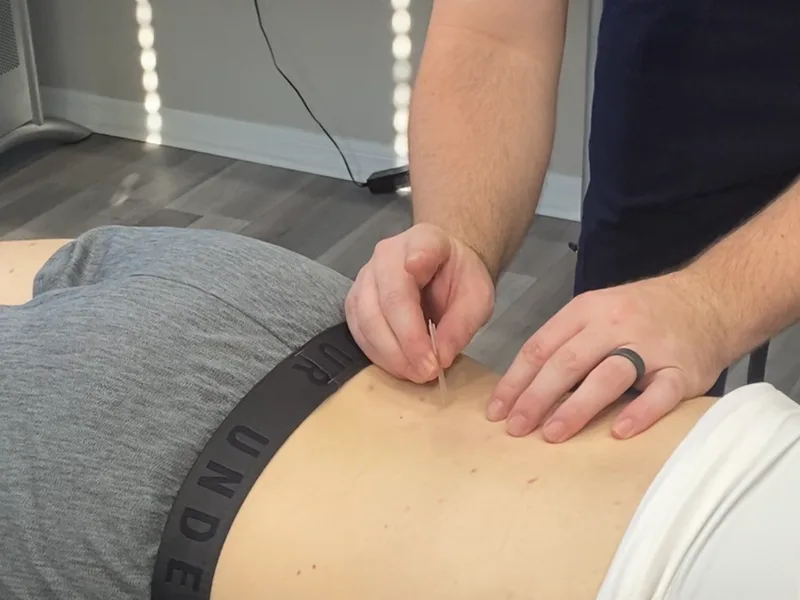 How Dry Needling works at Complete Chiropractic Sports & Wellness