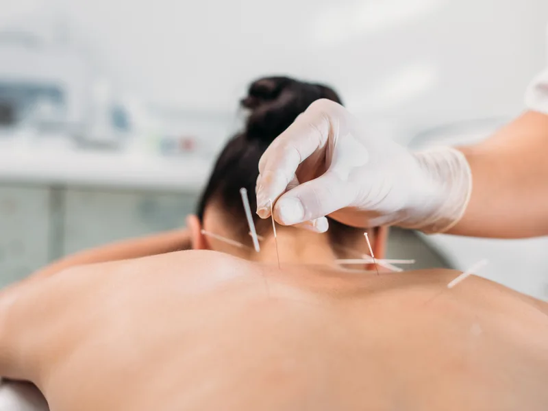 Dry Needling at Complete Chiropractic Sports & Wellness in Durham